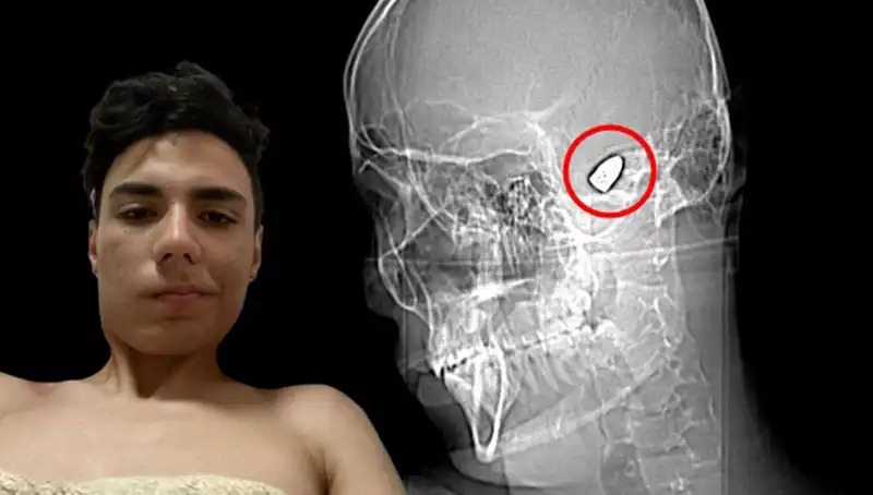 Kafasında Patlamaya Hazır Bomba Taşıyan Genç: İnanılmaz İfşa